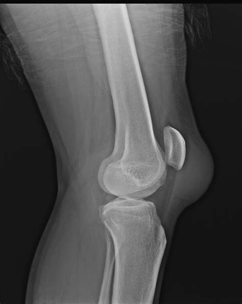 Pre Patellar Bursitis Image Radiopaedia Org