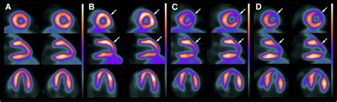 N Ammonia Pet Ct Detection Of Myocardial Perfusion Abnormalities In