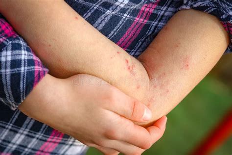 Une Dermatite Atepic De Blessures Entre Les Mains D Un Enfant Image