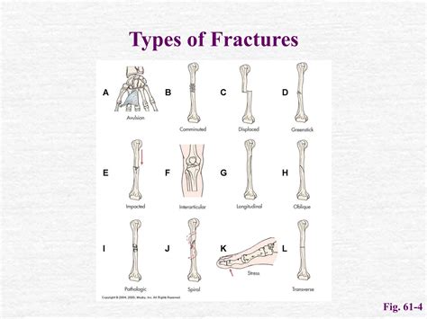 Fractures medical surgical nursing .ppt