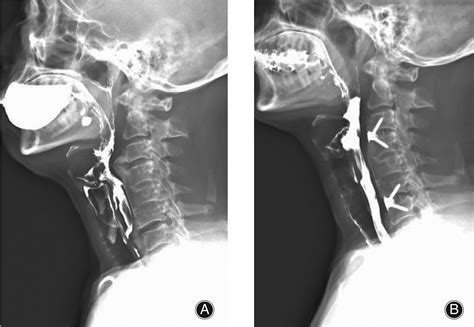 Cervical Osteophytes And Swallowing