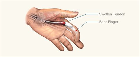 Flexor Tenosynovitis Trigger Finger