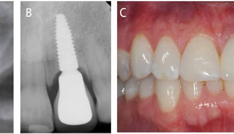 Implant Placement Decisions In Dentistry