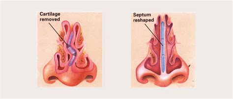 Turbinate Reduction - ENT Clinic