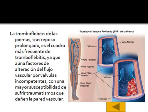 Dr David Caicedo Correa Tromboflebitis Imagenes Y Explicacion