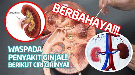 Ciri Ciri Gejala Penyakit Ginjal Dan Cara Ampuh Mengatasinya Youtube