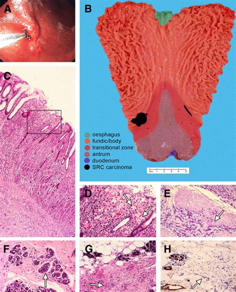 Hereditary Diffuse Gastric Cancer Diagnosis And Management Clinical