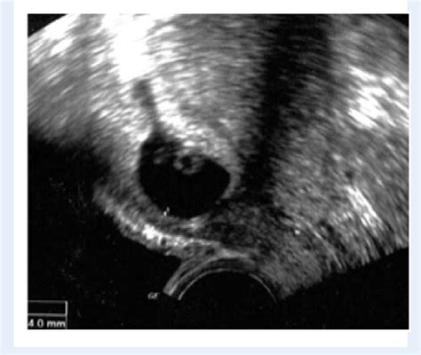 Ultrasound Image Of An Endogenous Caesarean Scar Pregnancy Type 1