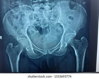 Xray Image Male Pelvis Osteoporosis Stock Photo Edit Now 269517038