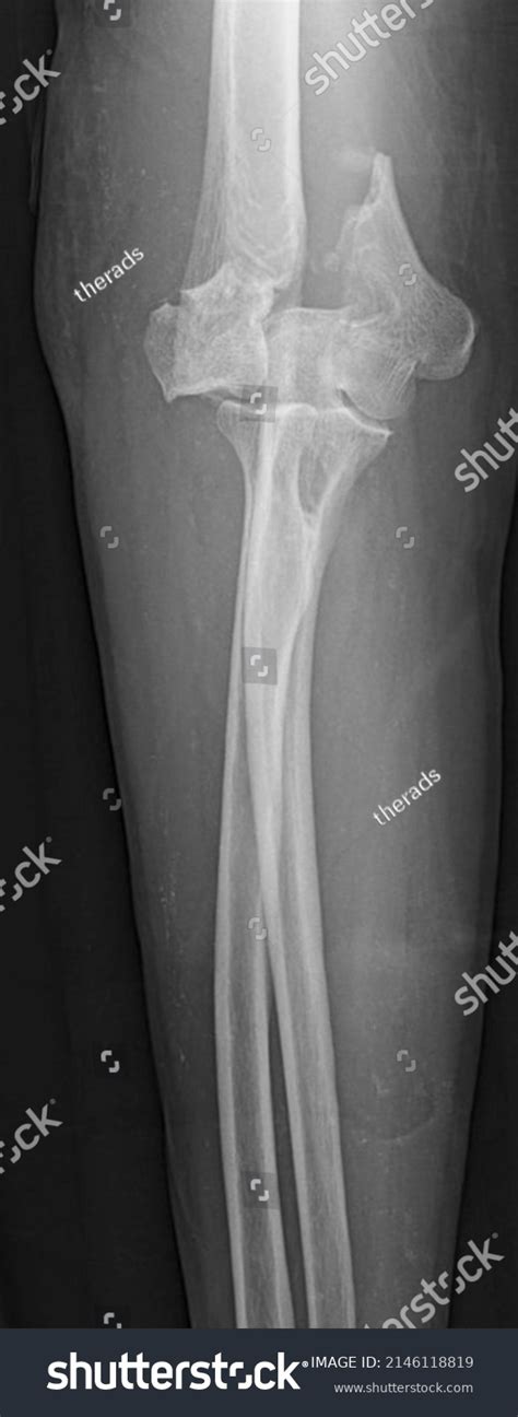 Xray Image Supracondylar Humerus Fracture Stock Photo