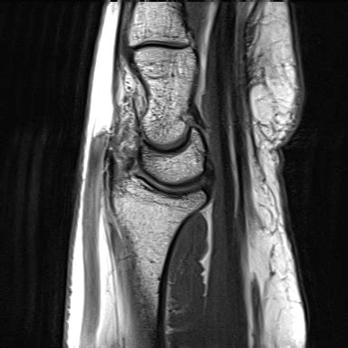 Traumatic Neuroma Bifid Median Nerve Image Radiopaedia Org