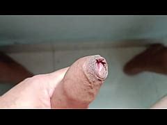 Removing The Foreskin Free Mobile Porn Videos IPornTV