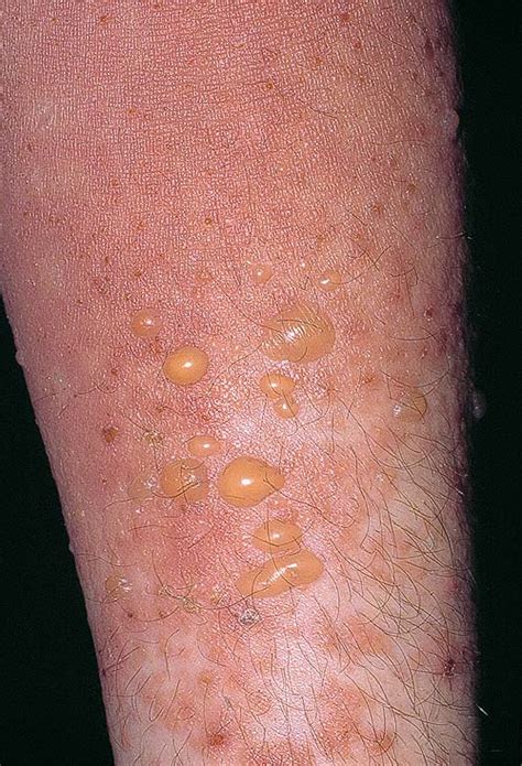 Bullous Pemphigoid - Pictures, Symptoms, Causes, Treatment, Prevention ...