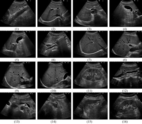 Abdominal Ultrasound Anatomy Image