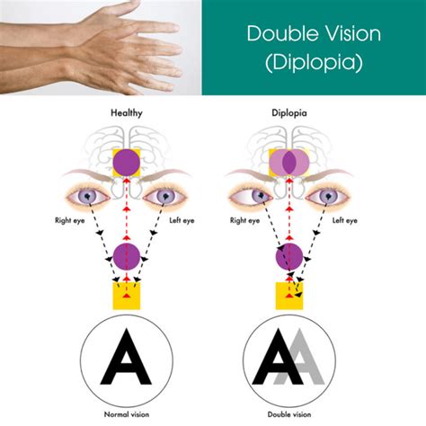 Diplopia Treatment Nyc Double Vision Treatment Options In Downtown Manhattan