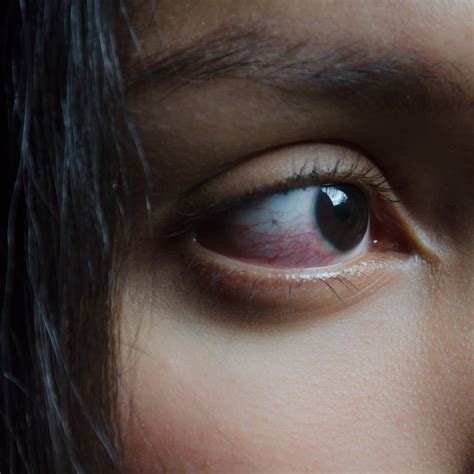 Ocular Rosacea The Real Reason For Your Bloodshot Eyes Allure