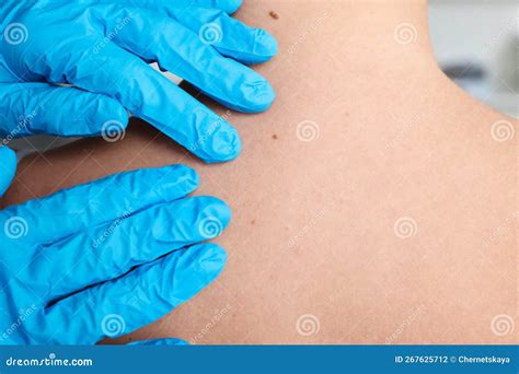 Dermatologist Examining Patient S Birthmark In Clinic Closeup Stock