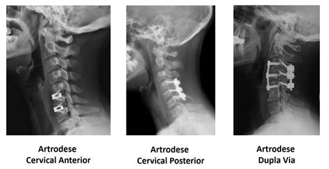 Artrodese Cervical Itc Vertebral