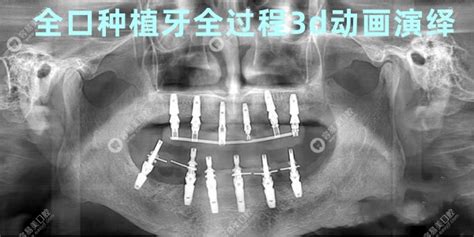 全口种植牙全过程3d动画演绎满口即刻负重种植流程行业动态容易美口腔