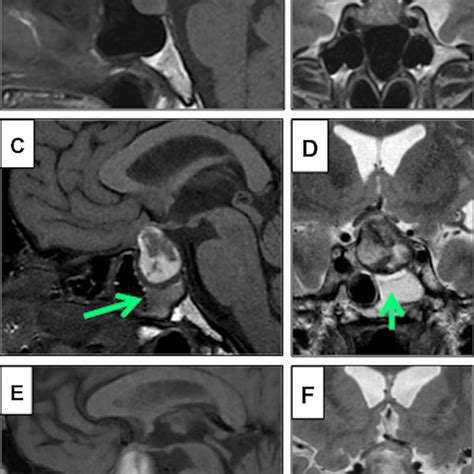 Examples Of Sphenoid Sinus Disease As Measured By The Sphenoid Sinus