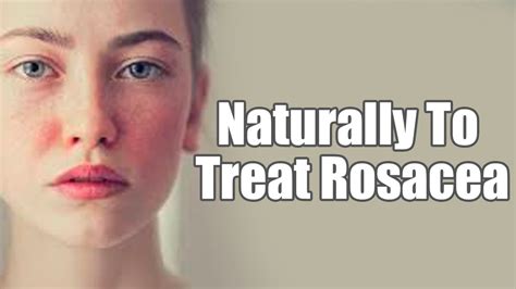 7 Remedies You Can Use To Naturally Treat Rosacea Boldsky Youtube