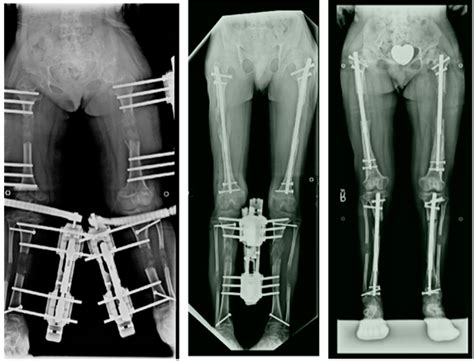 Children Free Full Text Extensive Limb Lengthening For