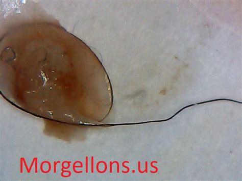 Shapes of Morgellons Disease The Silent Pandemic – fibromyalgia, Shingles & lyme disease ...