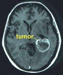 A Stock Photos: brain tumor stages