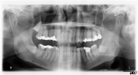 Radiography, Bitewing; Bitewing Radiography