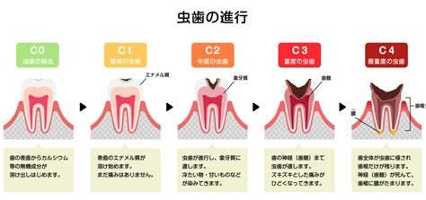 虫歯を放置するとどうなる？ 大阪府吹田市千里山の歯科