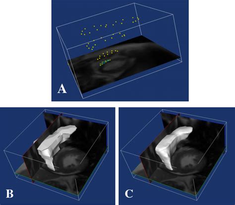 Figure From Improved Quantification Of Right Ventricular Volumes From