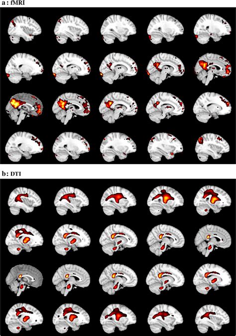 Joint ICA Of FMRI And DTI Data Component 6 Of 8 Demonstrated The DMN