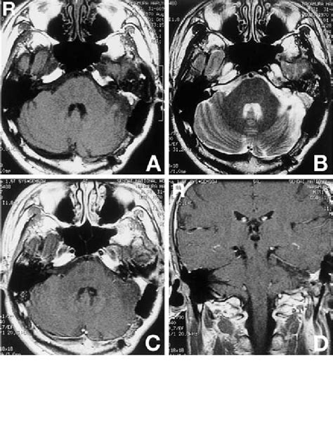 Follow Up Magnetic Resonance MR Images At 7 Years After Treatment