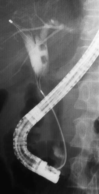 Nonvascular Interventional Procedures | Radiology Key