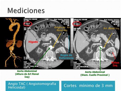 Ppt Tratamiento Endovascular Aaa Powerpoint Presentation Free