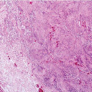 Patient S Histopathology Encapsulated Biphasic Spindle Cell Neoplasm