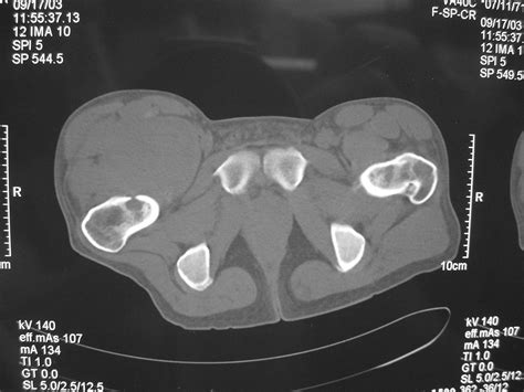 Synovial Sarcoma Soft Tissue Sarcoma