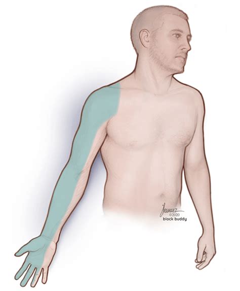 Interscalene Block Ultrasound Guided Technique Block Buddy