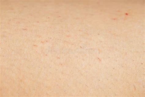 Ingrown Hair And Irritated Skin On The Leg Of A Woman Stock Image