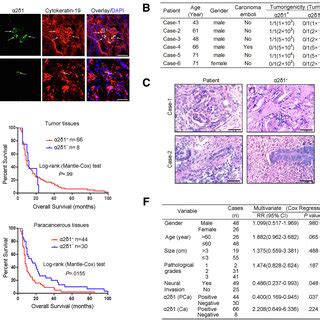 Clinical Significance Of A D Expression In Pdac And Paracancerous