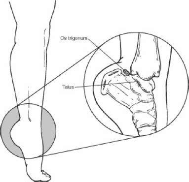 Os Trigonum Syndrome - Foot and Ankle Specialists of Middle Tennessee