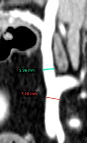 Extrahepatic portosystemic shunt in a dog - ProtonVet