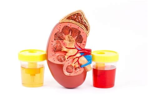 Salud Renal Hematuria Sangrado En La Orina