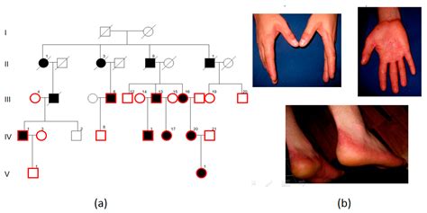 Ijms Free Full Text Palmoplantar Keratoderma A Molecular Genetic