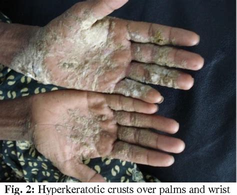 Figure 1 From Crusted Norwegian Scabies Two Case Reports With Hiv