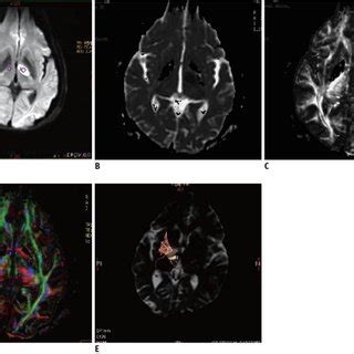 Diffusion weighted imaging and diffusion tensor imaging scans from ...