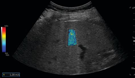 Liver Fibrosis Ultrasound