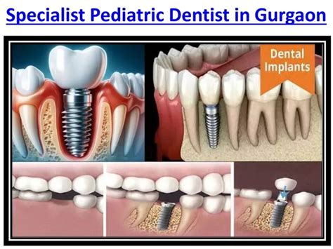 Ppt Painless Root Canal Treatment Dentistry In Gurgaon Powerpoint