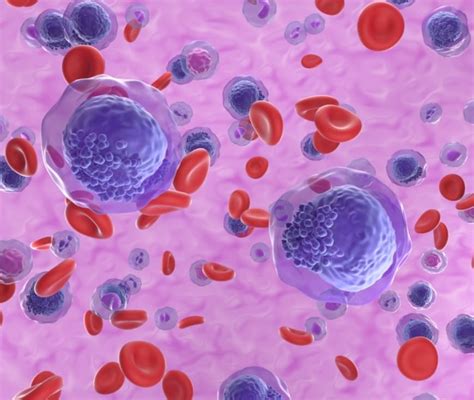 Leucemia Trapianto Di Cellule Staminali E Di Midollo Osseo