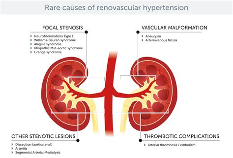 Beyond Atherosclerosis And Fibromuscular Dysplasia Rare Causes Of Renovascular Hypertension